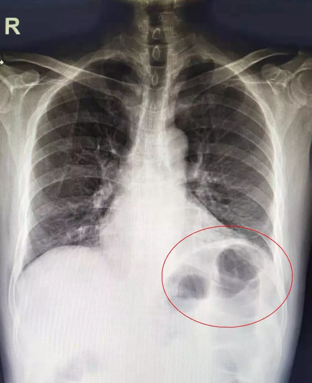 邓女士的ct显示胃泡在右