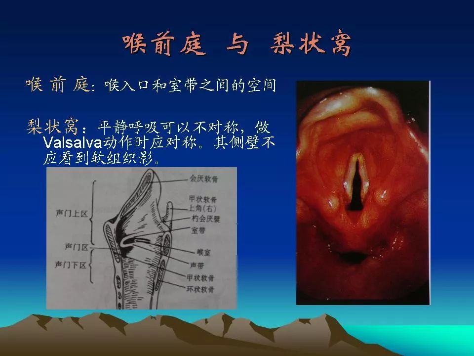 喉癌的ctmri诊断影像天地