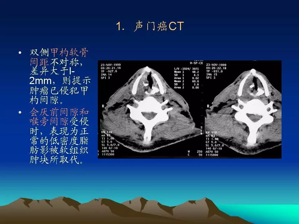 喉癌的ct,mri诊断
