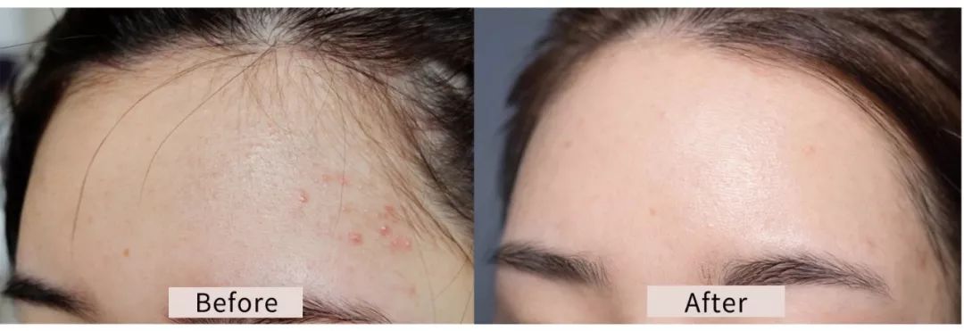 10分钟搞定闭口黑头这款清洁面膜我能回购10000年