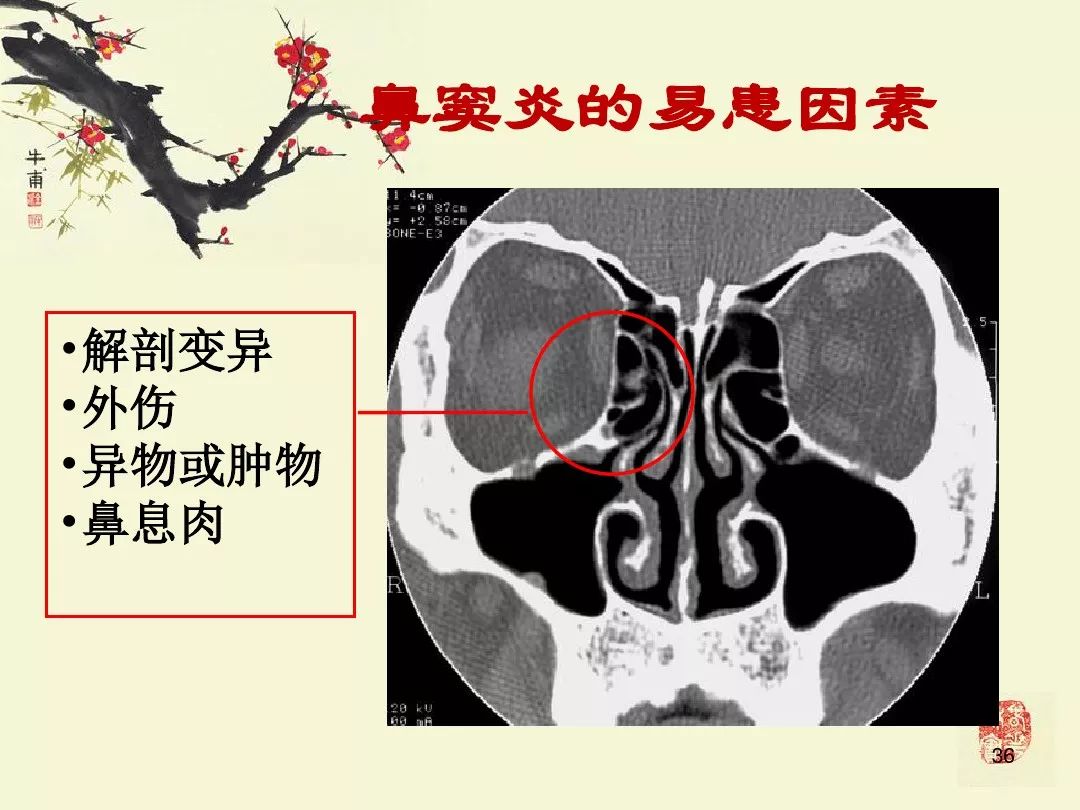 鼻窦炎ct图片详解片子图片