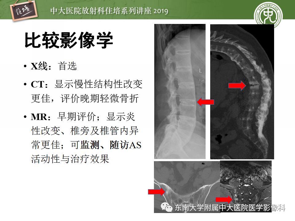 中大放射住培系列讲座第71期强直性脊柱炎影像学评估