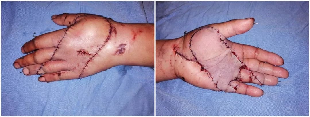 路桥一男子手掌被近2吨模具压手上,手掌顿时四分五裂.