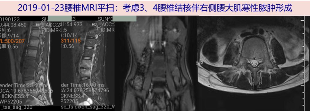 探案:初二男生腰痛2月,核磁报告腰椎结核:您信吗?