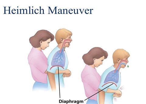 heimlich maneuver图片