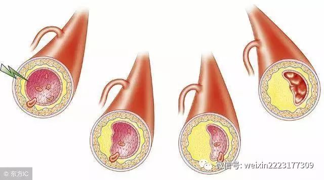 頸動脈斑塊3515mm對人體的危害有多大真的會得腦梗嗎