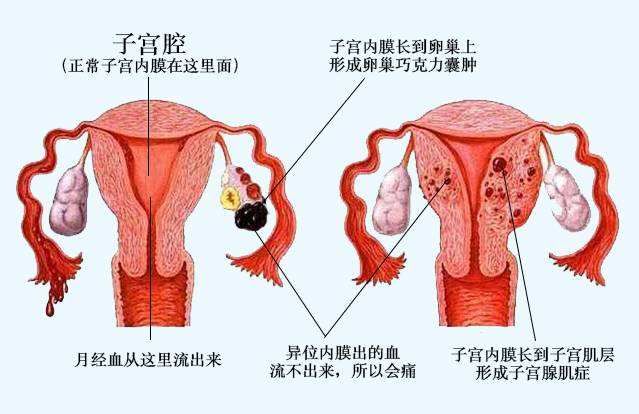 又叫异位,跑出子宫腔的内膜所产生的陈旧性血液聚集在囊内形成咖啡色