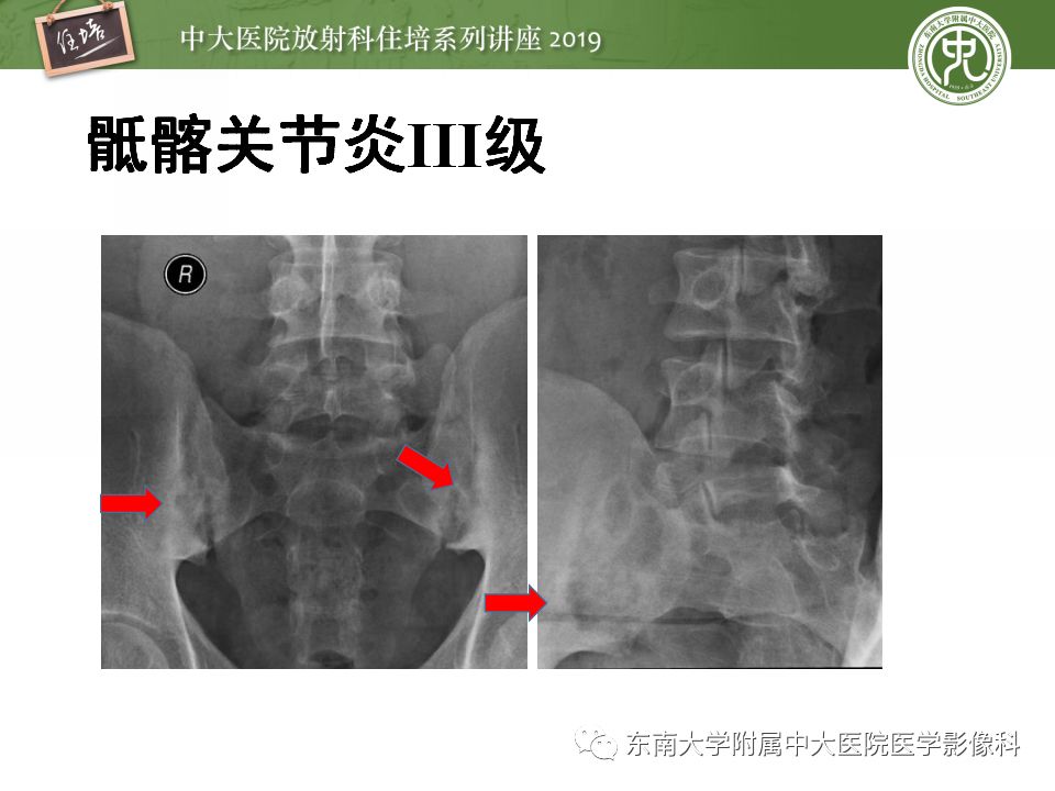中大放射住培系列讲座第71期强直性脊柱炎影像学评估