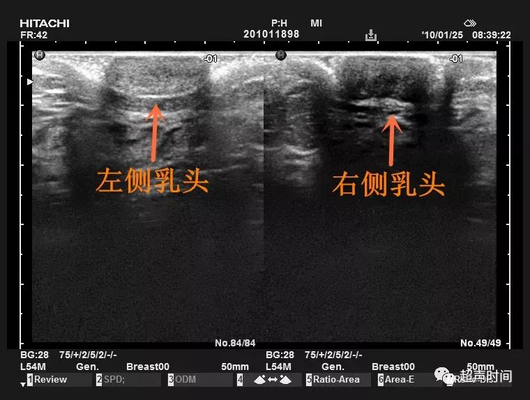 paget乳腺癌图片图片