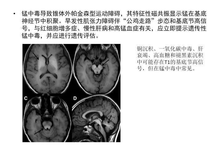继发性帕金森综合征锰沉积
