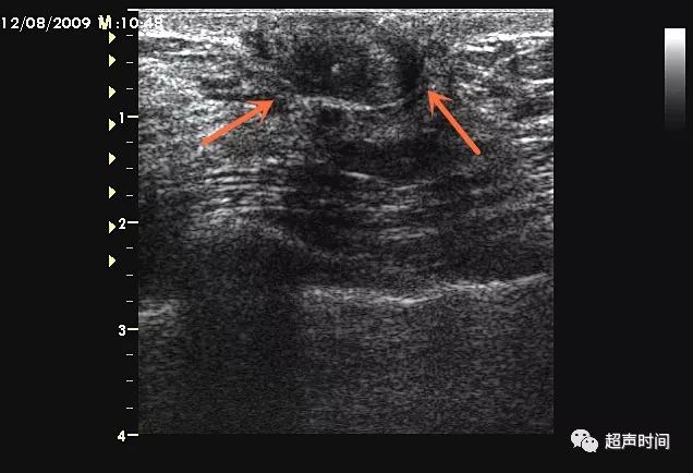乳头paget病少见易漏诊你遇到过吗