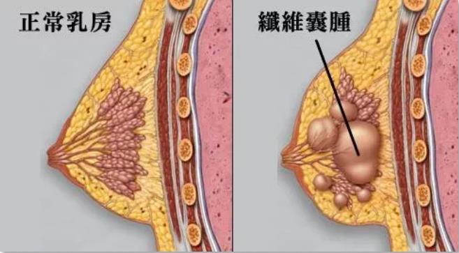 粉红天使告诉你关于乳腺囊肿的真相与谎言!