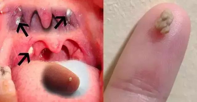 但是极易导致扁桃体炎症,大的扁桃体结石严重的只能扁桃体摘除手术