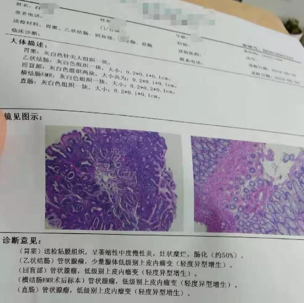 肠道腺瘤因何盯上花季少女