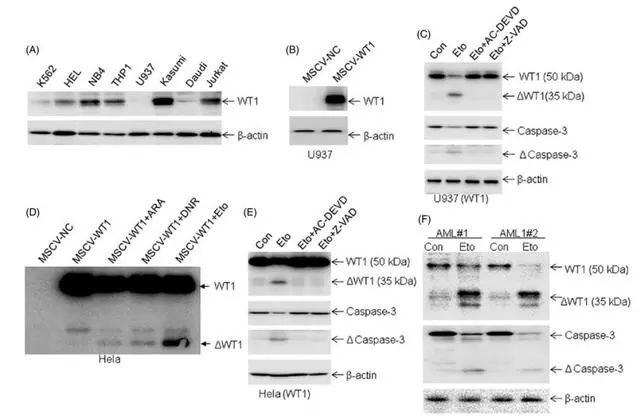 温州医科大学附二医院发现白血病人中wt1基因的调控新机制
