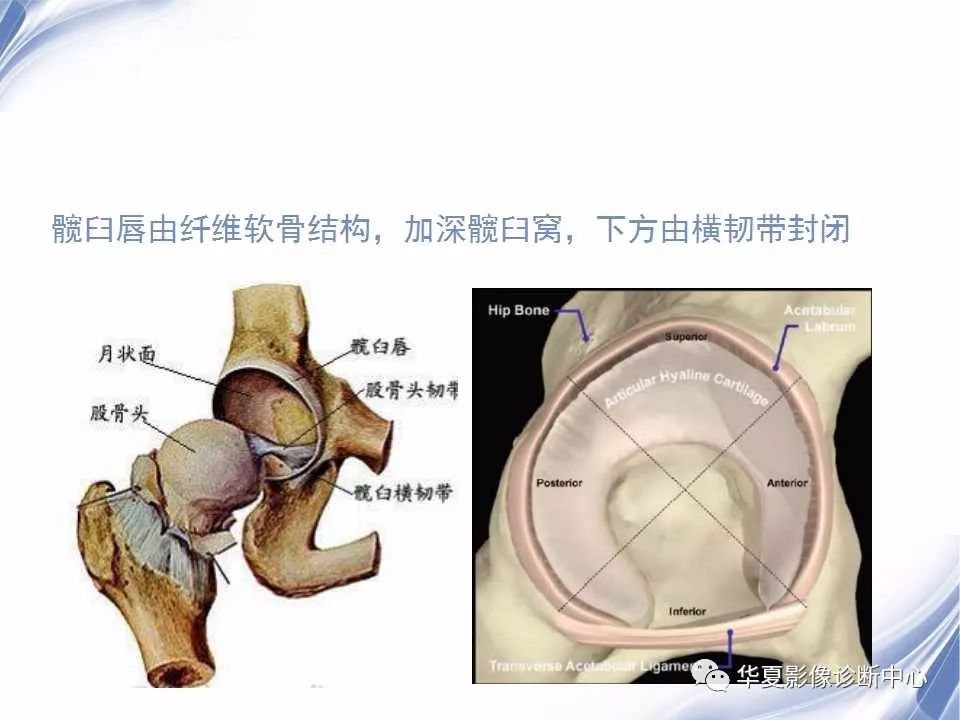 示意图钳样撞击征是股骨头颈连接处与髋臼缘反复撞击导致关节唇退变