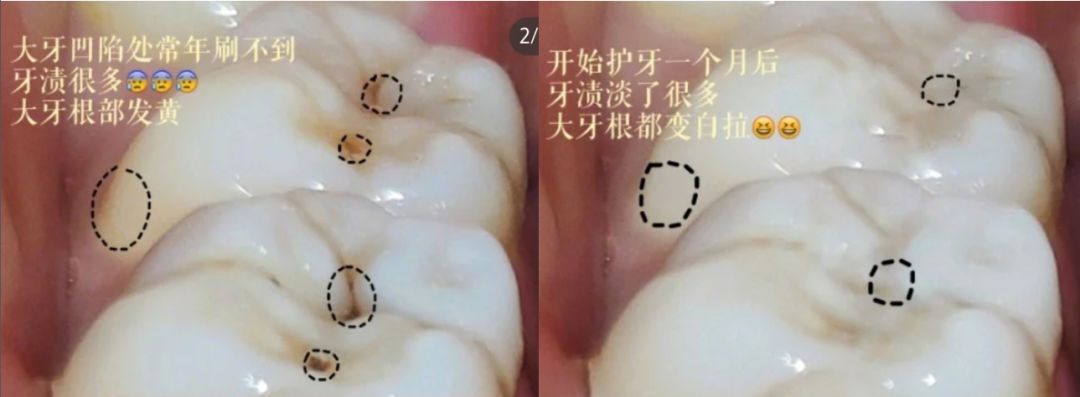 这是什么神仙漱口水20秒就把牙渍牙垢清干净牙齿还白两度