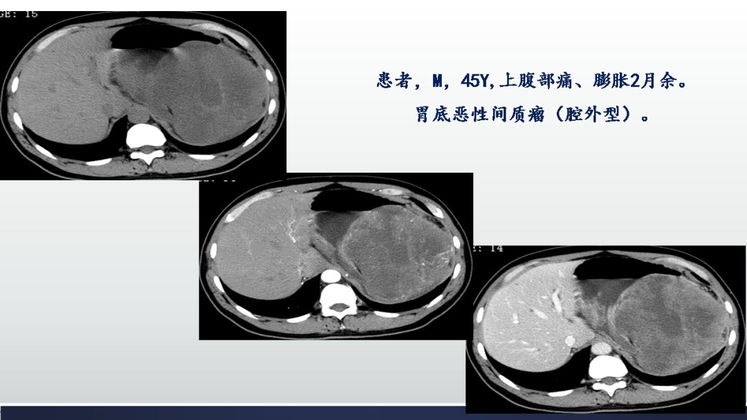 胃肠道间质瘤(gist)影像表现_肿瘤