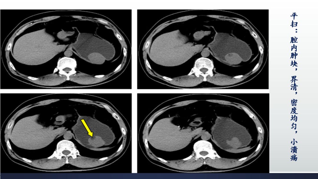 胃肠道间质瘤gist影像表现