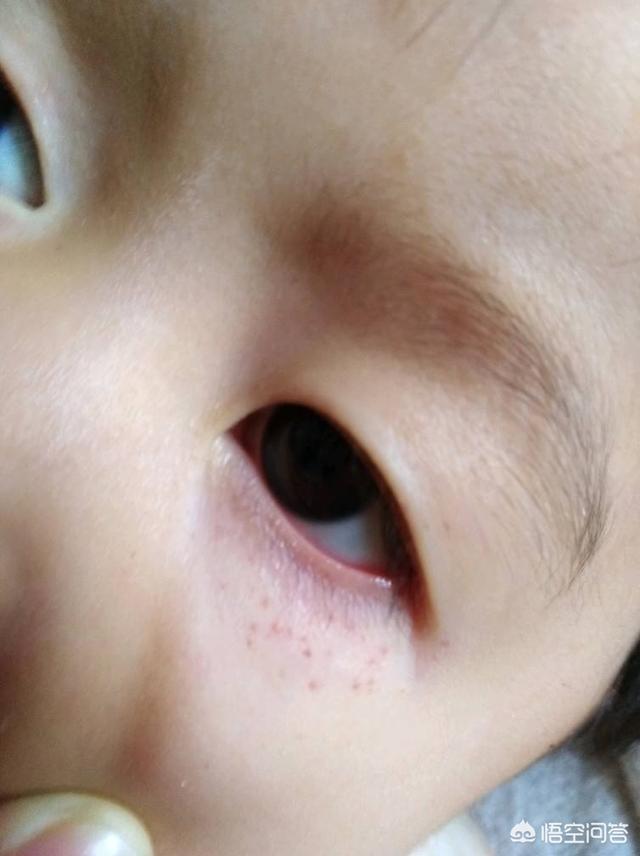 鼻泪管堵塞:宝宝眼睛流黄水也是新生儿泪囊炎的症状之一,意思是鼻泪管