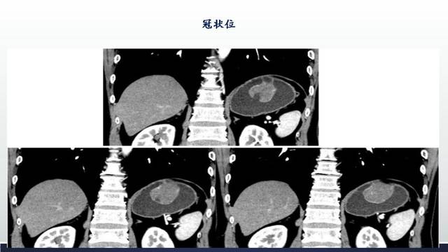 胃腸道間質瘤gist影像表現