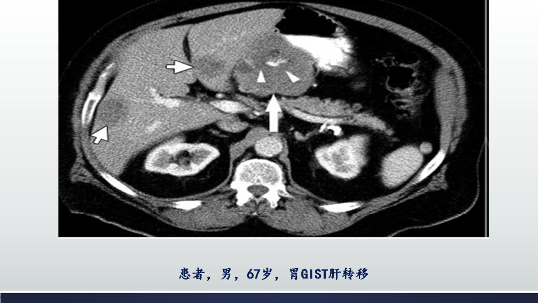 胃肠道间质瘤(gist)影像表现_肿瘤