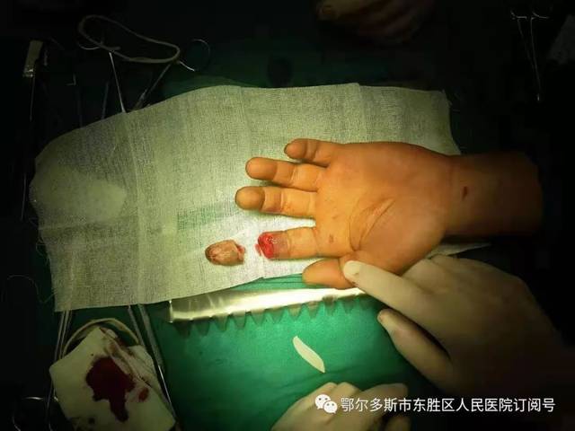 973资讯全断离也能接上鄂尔多斯这家医院成功进行断指再植手术