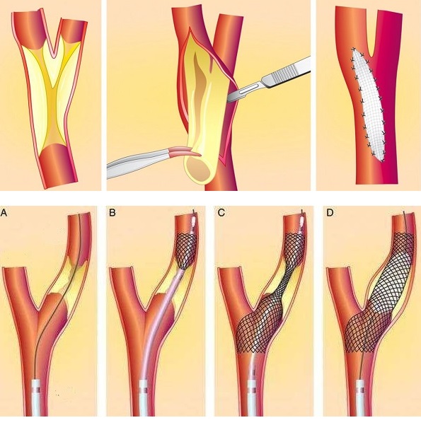 拯救颈动脉斑块记住这几点医生终于说出了大实话