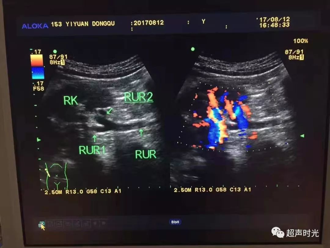彩超重复肾声像图片图片