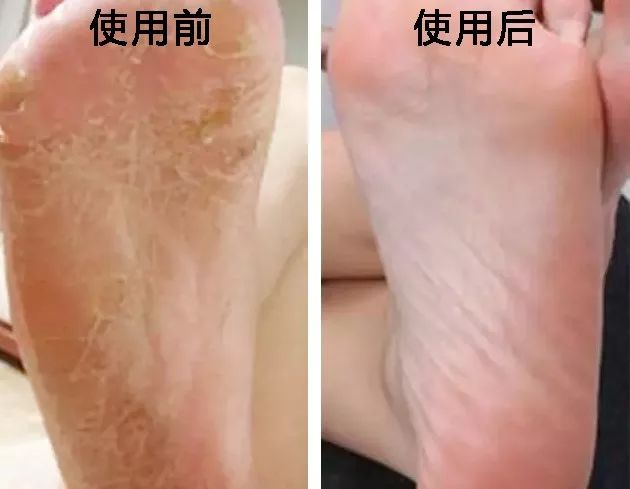 使用前后对比还是挺明显的, 干燥起皮的裂痕都没了.