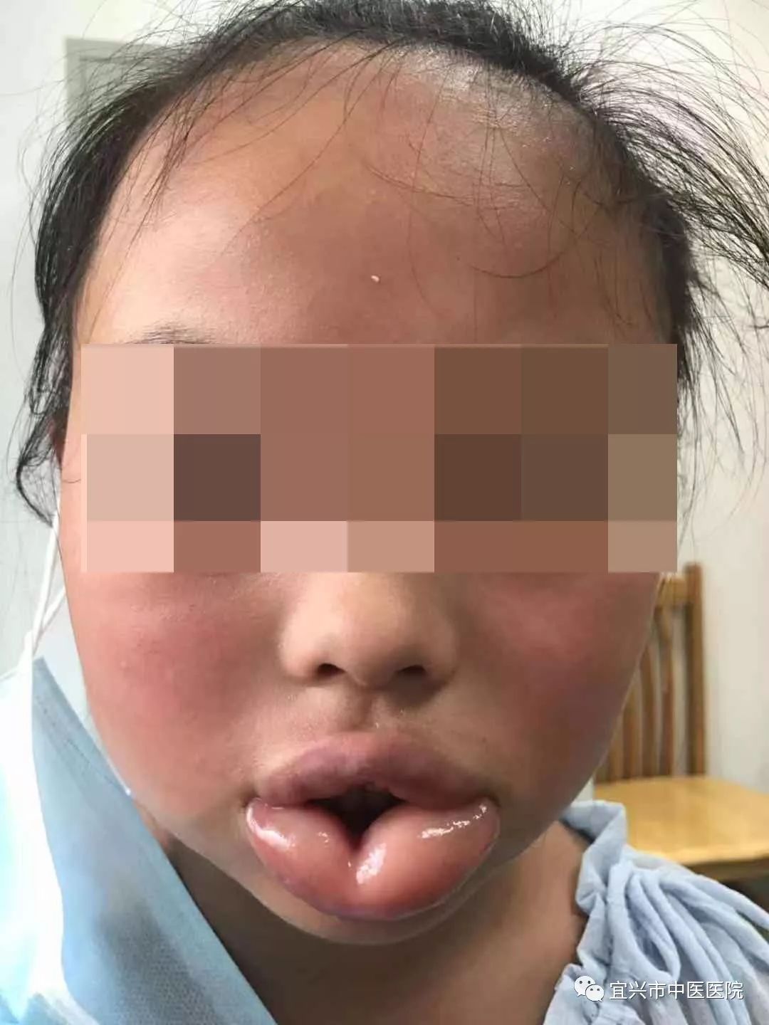 宜兴10岁女童咬了一口水蜜桃嘴唇肿得像香肠喉头水肿差点窒息