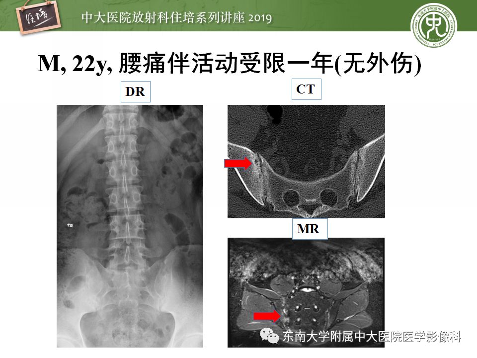 中大放射住培系列讲座第71期强直性脊柱炎影像学评估