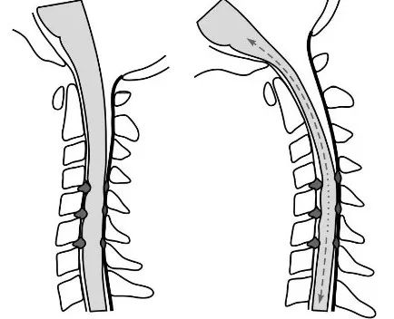 颈椎病老年患者的疾病类型多为"脊髓型颈椎病",且往往具有病程较长,多