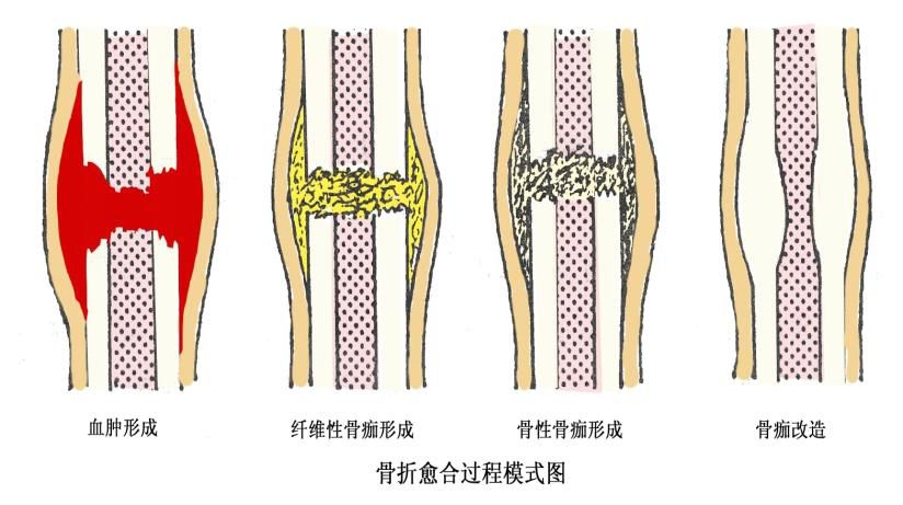 骨痂生成图片