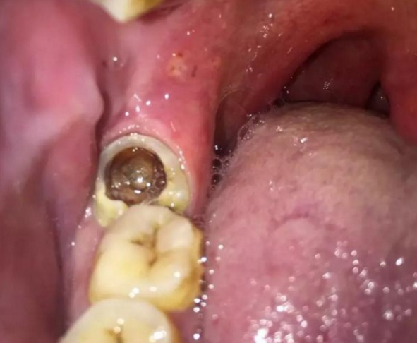 最后一颗大牙坏了一个洞,现在牙龈好痛,该怎么办呢?