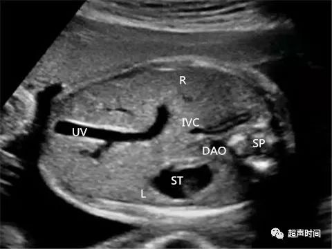 胎儿下腔静脉缺如:看懂这个病例就学会了诊断