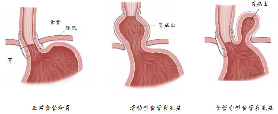 先天性胸腹裂孔疝图片