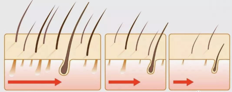 详解脱发毛囊退化,毛囊死亡,毛囊萎缩之间的区别_头发