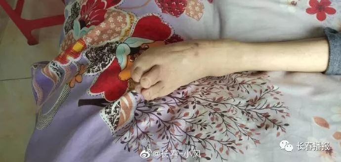 任刚双下肢瘫痪(双下肢肌力i级)及二便失禁的情况属完全丧失劳动