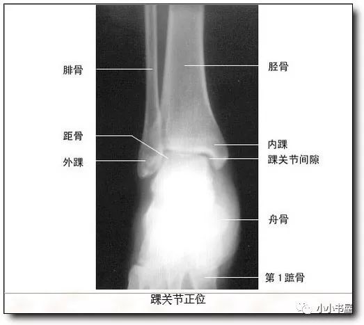 踝关节由三块骨组成,胫骨,腓骨和距骨,由胫,腓骨下端的下关节面,和
