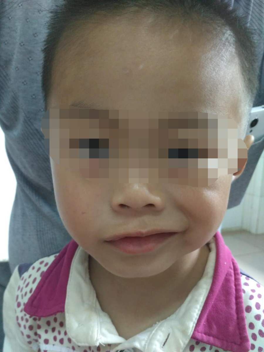 原创4岁女孩一觉醒来嘴歪了医生忠告夏天每家都在用父母要当心