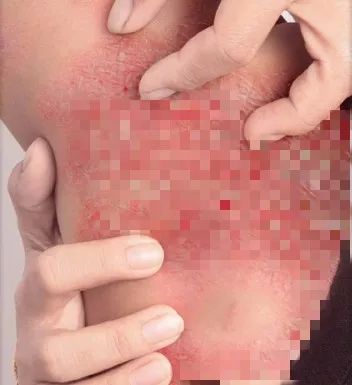 家有特异性皮炎孩子的看过来,我们正在做这项临床研究