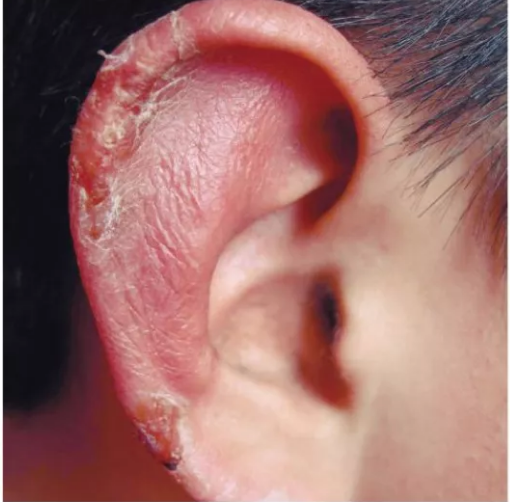 耳廓化脓性图片