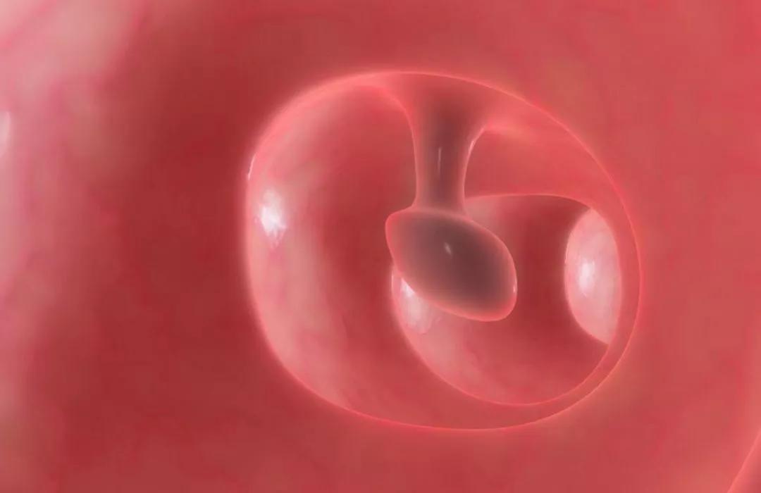 【丰溪堂中医院】我叫"息肉",很容易变成癌!