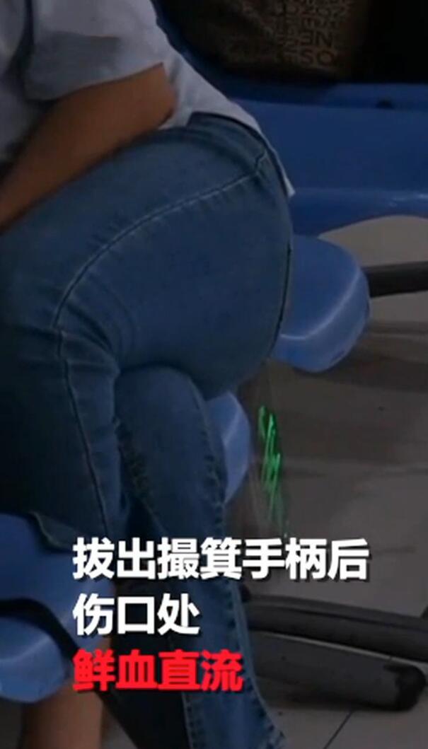 扫帚柄插进女子肛门老公吓坏赶紧拔出医生肛管撕裂了4厘米