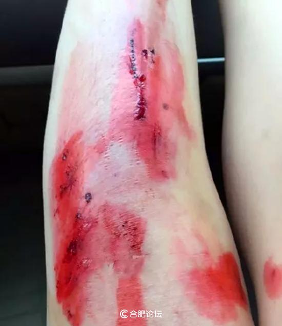 出车祸腿受伤的照片图片
