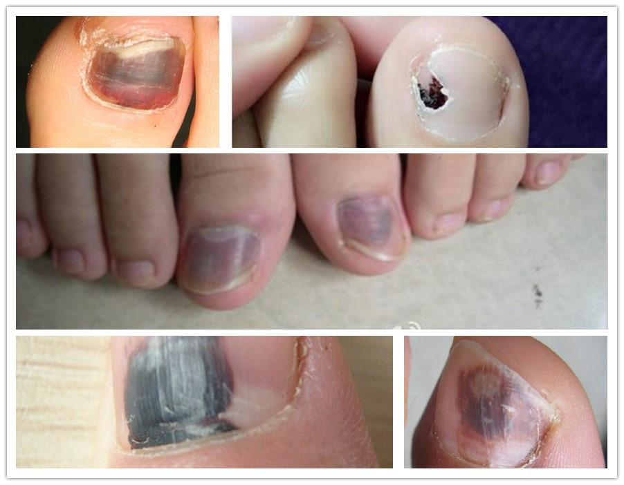 保证不摔倒就能预防脑出血医生这2种人不摔倒也会脑出血