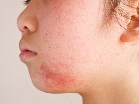 你的皮肤是真敏感吗_肌肤