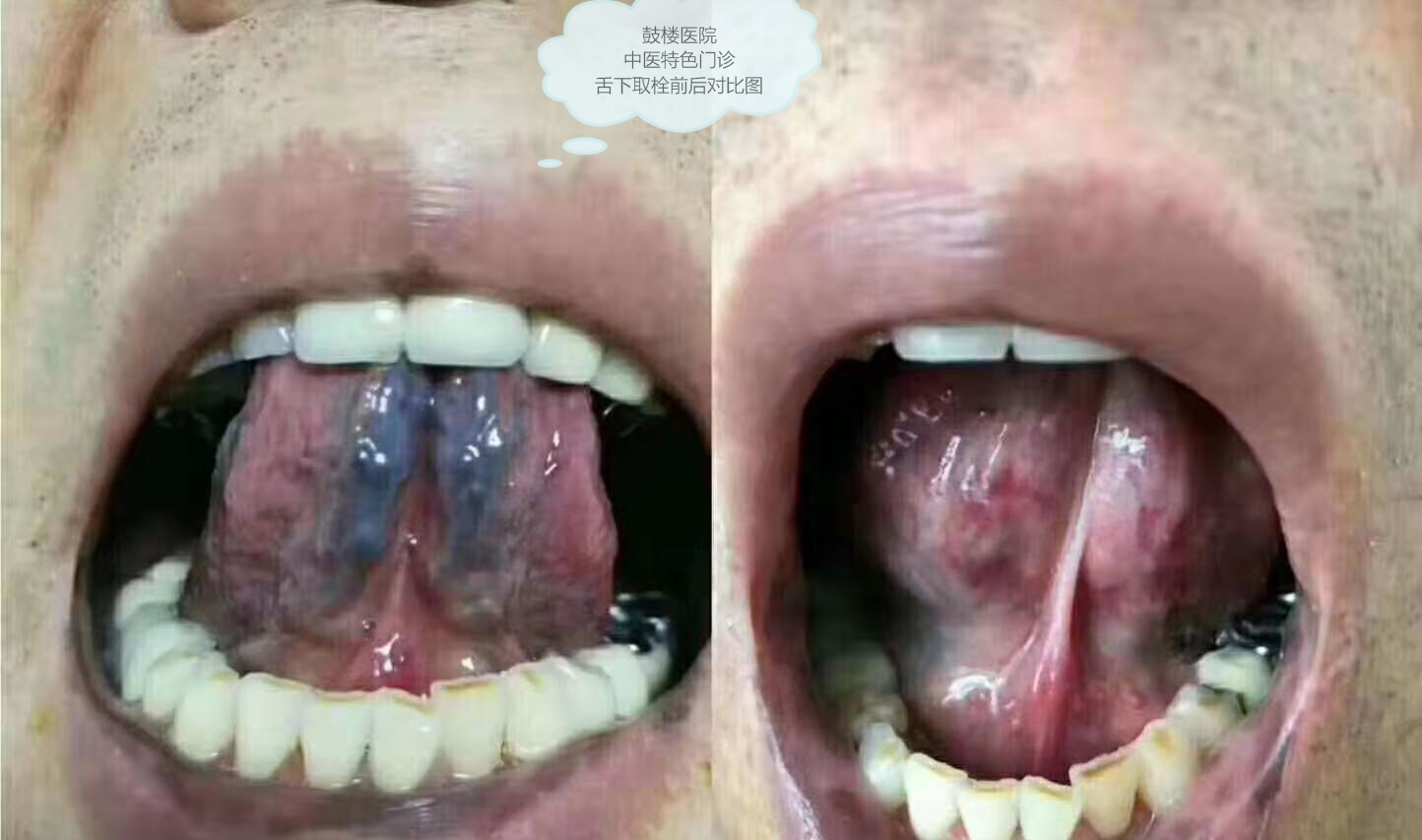 舌下取栓视频过程图片
