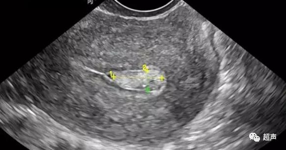 超声微课堂 子宫内膜息肉的超声表现